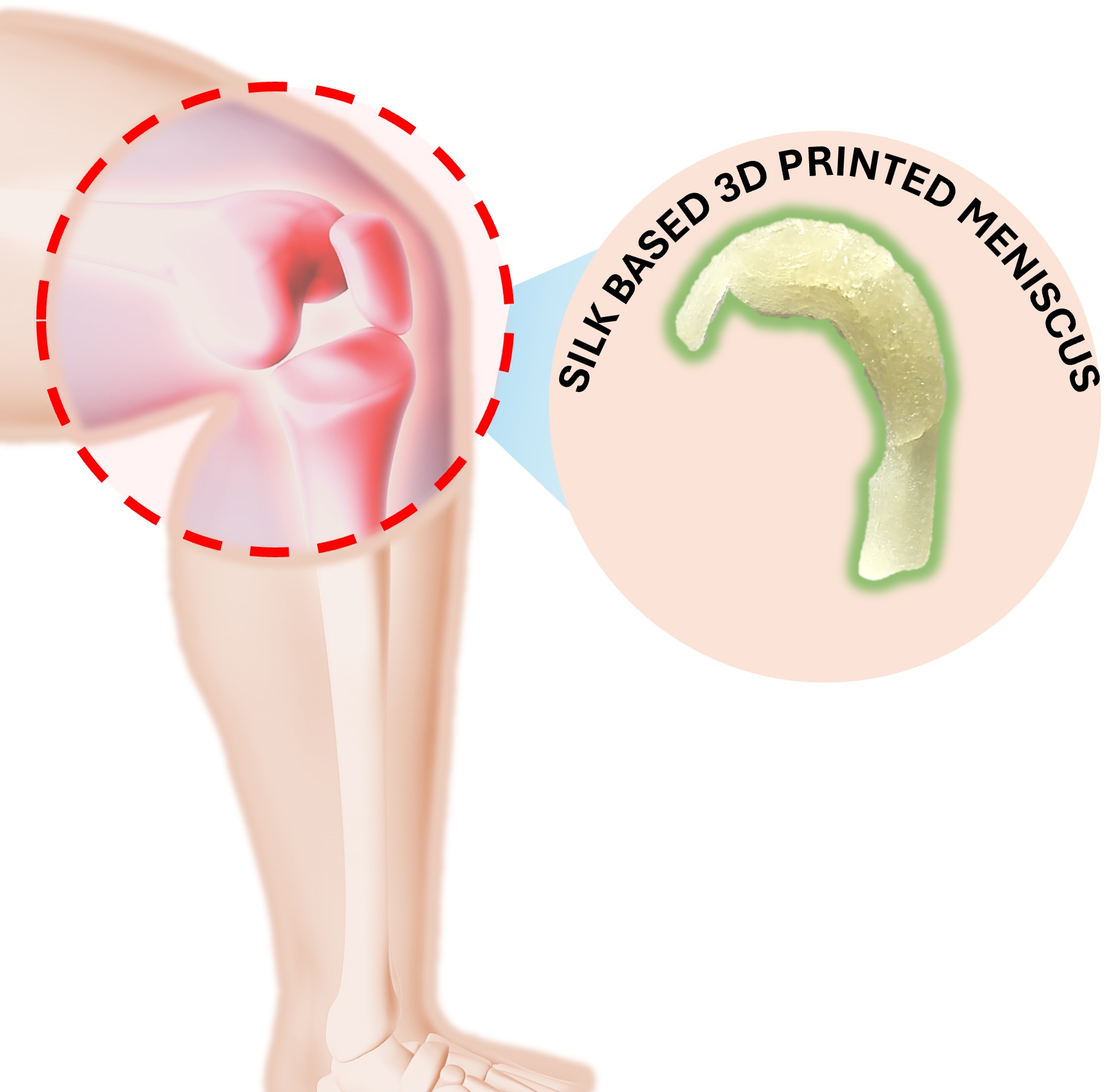 IIT Guwahati Researchers Develop Tailored Solutions Based on Regenerative Therapies for Knee Meniscus Tears